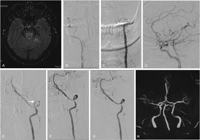 Staged Endovascular Treatment for Symptomatic Occlusion Originating From the Intracranial Vertebral Arteries in the Early Non-acute Stage